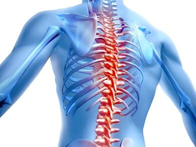 Spinal Läsion mat Osteochondrose