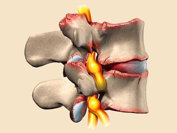 Spinal Verletzung bei der thoracescher Osteochondrose