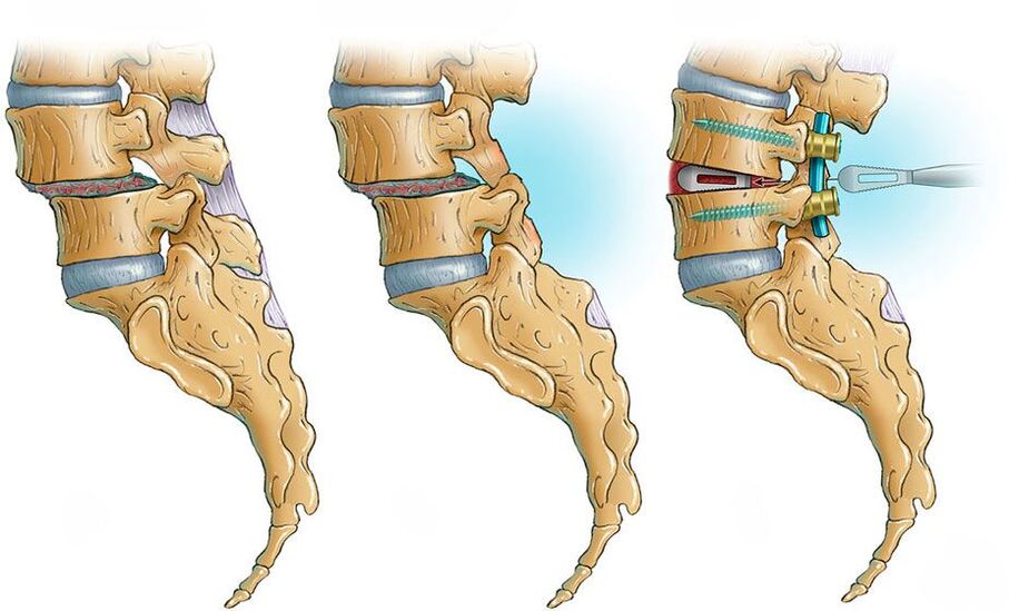 Spinal Deformitéit