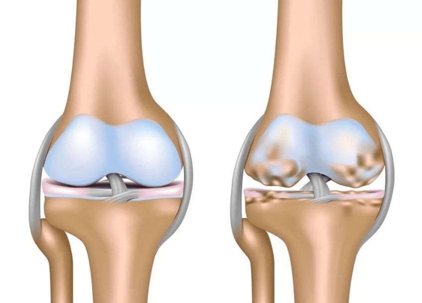 Arthrosis