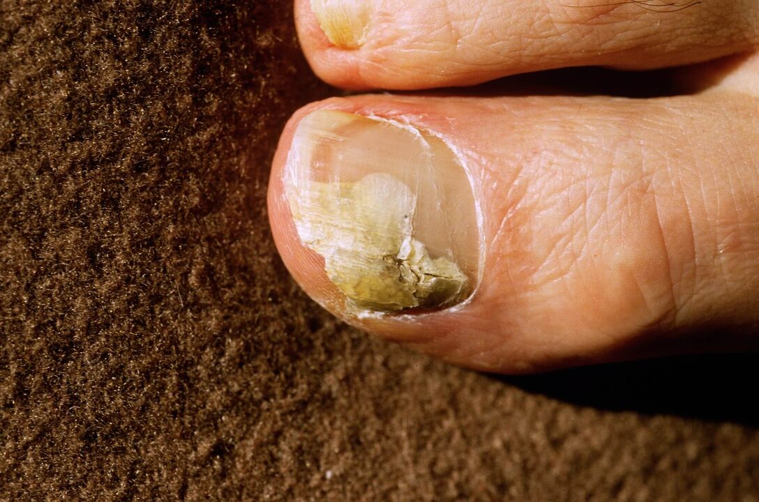 Onychoycosis