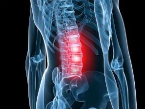 Osteochondrosis vun der Lendegpigelen