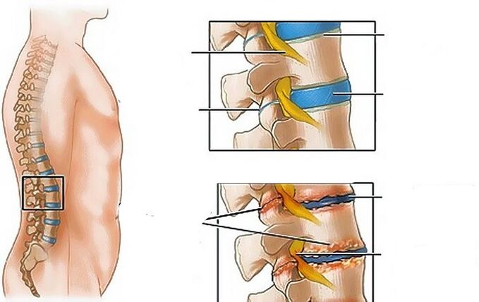 Osteochondrosis vun der Lendegregioun