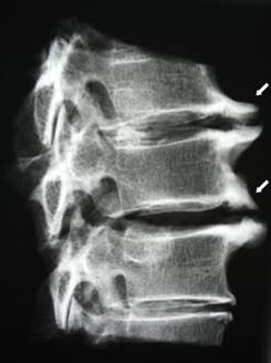 Osteophyte vun der Gebärmutterkierper verursaachen Hals Schmerz