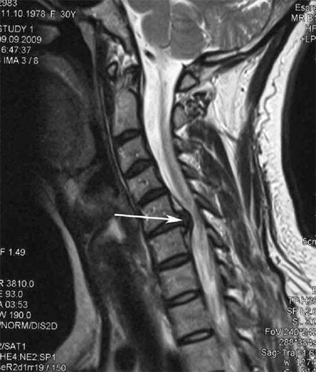 Spinalkordverletzung verursaacht Hals Schmerz