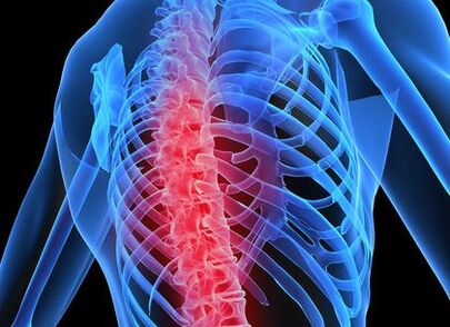 Osteochondrose vun der thoracic Wirbelsäule