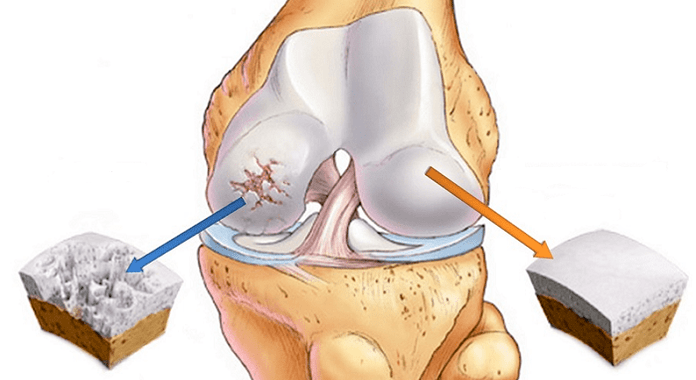 gesonde Knorpel a Knorpel betraff vun Arthrosis