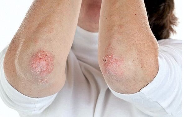 Leit mat Psoriasis sinn ufälleg fir psoriatesch Arthritis