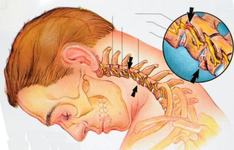 wat geschitt mat cervical osteochondrosis