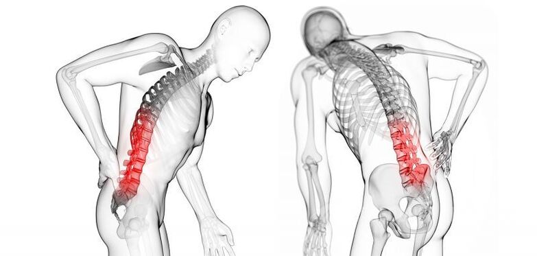 Komplikatioune mat zervikaler Osteochondrose