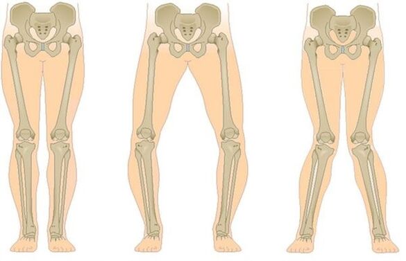 Aarte vun Arthrosis