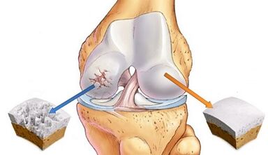 D'Grënn fir d'Entwécklung vu Arthros vun de Gelenker