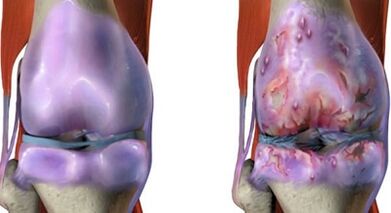 D'Haapt Differenzen vun Arthritis an Arthrosis