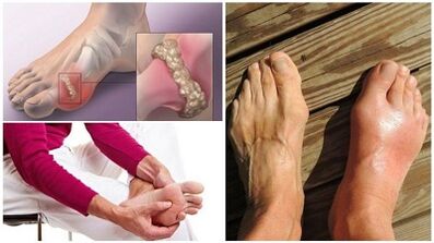 Wat ass Arthritis vun de Gelenker
